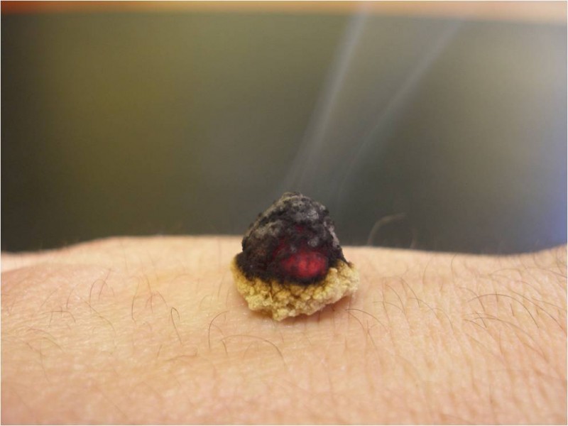 moxibustion_japonaise_sionneau1
