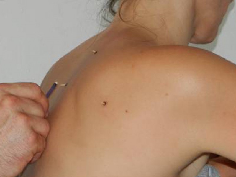 moxibustion_japonaise_sionneau3