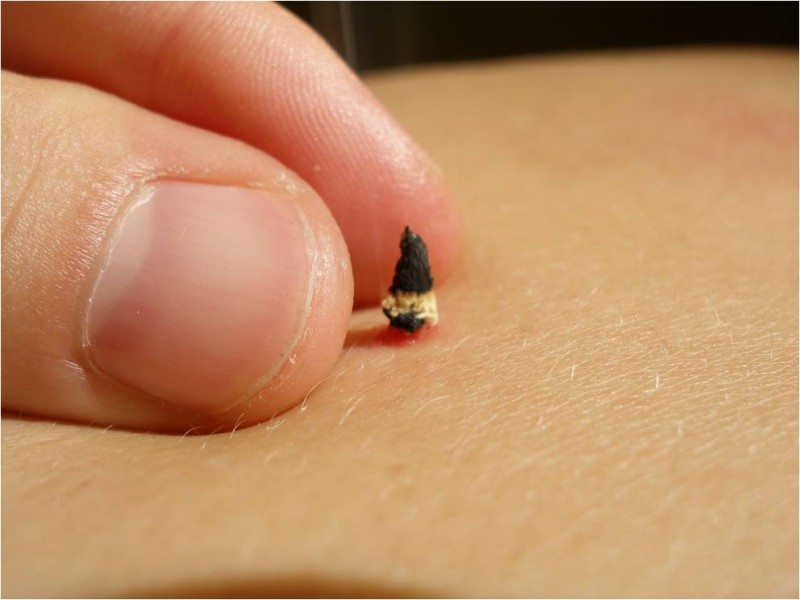 moxibustion_japonaise_sionneau4